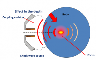 Ieder Automatisch vaas Radiale shockwave (RSWT) en gefocusseerde shockwave therapie (FSWT): wat is  het verschil?